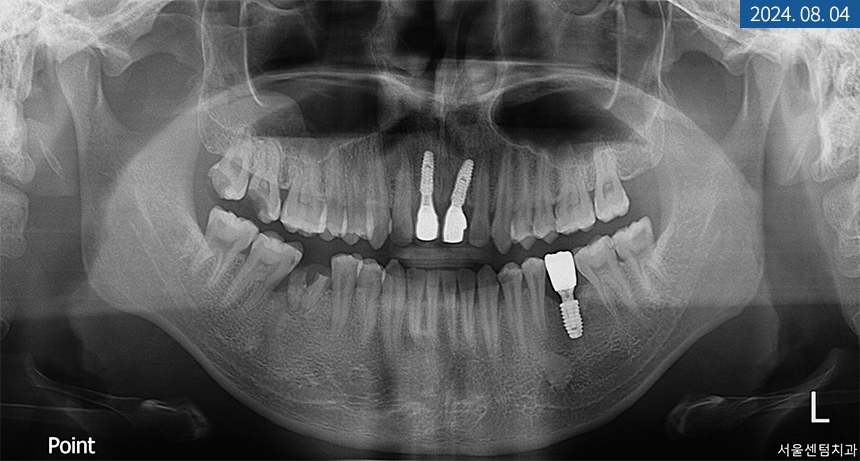 앞니 임플란트 식립으로 저작 기능을 끌어올린 증례 관련 이미지 15