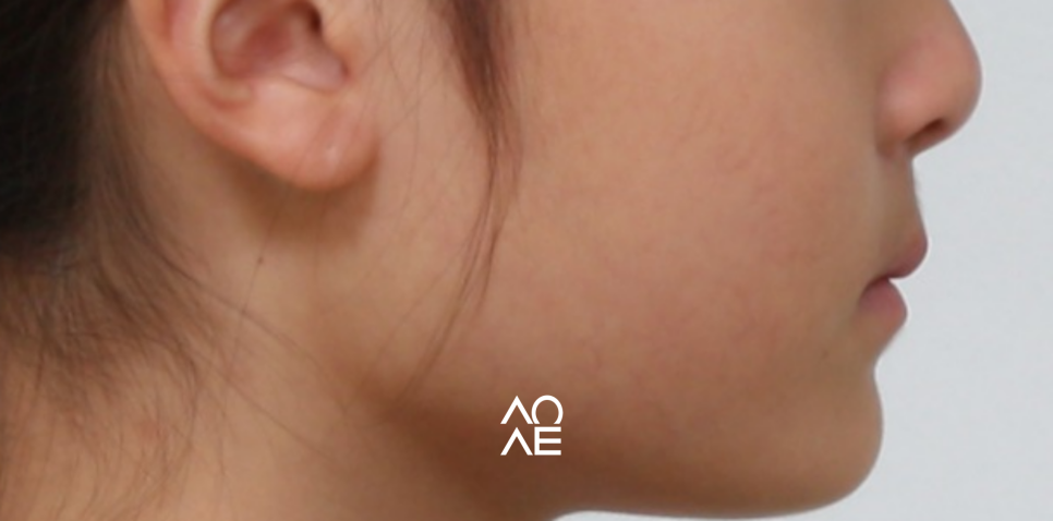 주걱턱 교정, 페이스마스크 활용 주의사항 관련 이미지 7