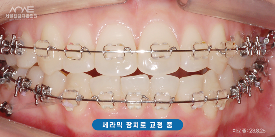 총생 앞니 덧니 발치 후 치아교정? 관련 이미지 6