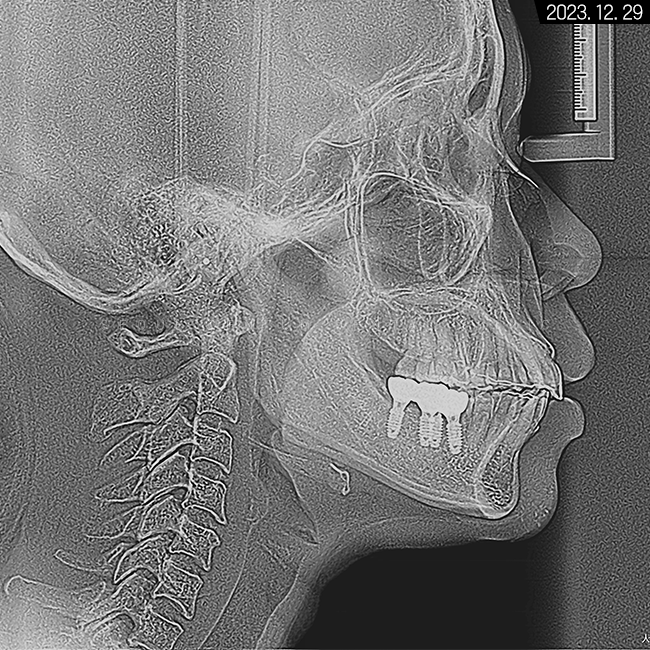 돌출입 및 신경치료와 임플란트 식립 동시 진행 증례 관련 이미지 30