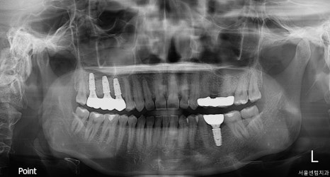 40대 임플란트 치료 케이스 상악동거상술 골이식까지 관련 이미지 16