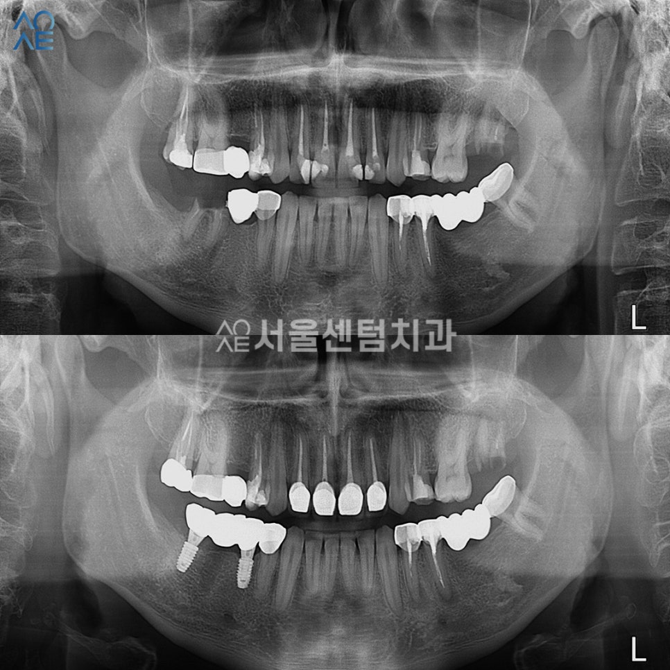 20대임플란트 처음이라 두렵다면 관련 이미지 6