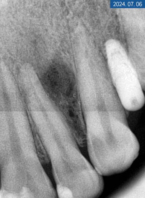 뼈이식 임플란트와 라미네이트 수복 증례 소개 관련 이미지 12