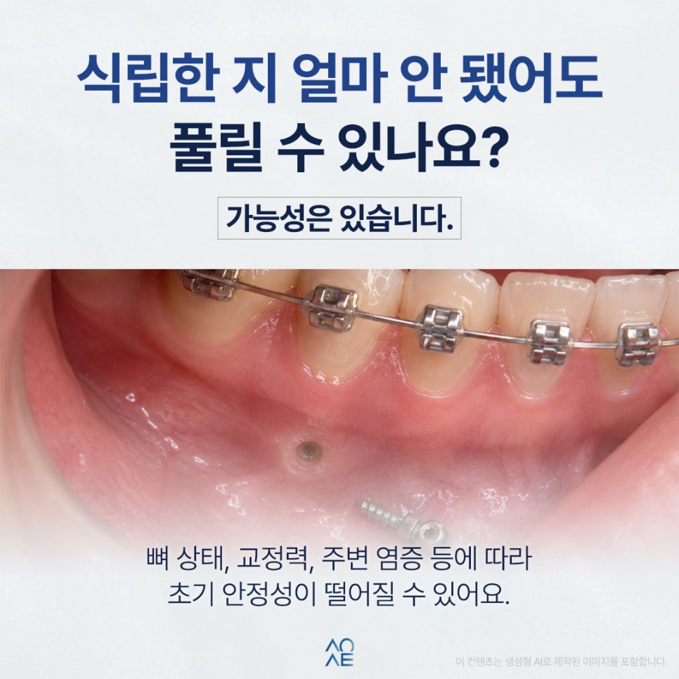 교정 미니스크류 풀리는 것 같은데 그대로 내버려둬도 되나요? 관련 이미지 3