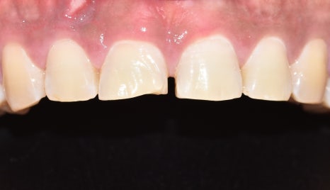 치과 마취 종류 풀리는 시간 주의사항에 대해서 관련 이미지 9