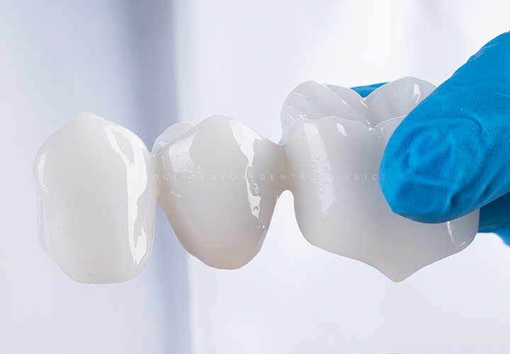 치아브릿지가격 종류에 따른 안내와 장단점 설명 관련 이미지 2