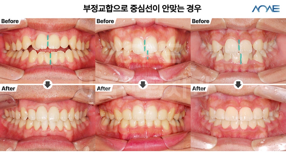 치아중심선교정 다양한 실제사례 보여드려요 관련 이미지 4