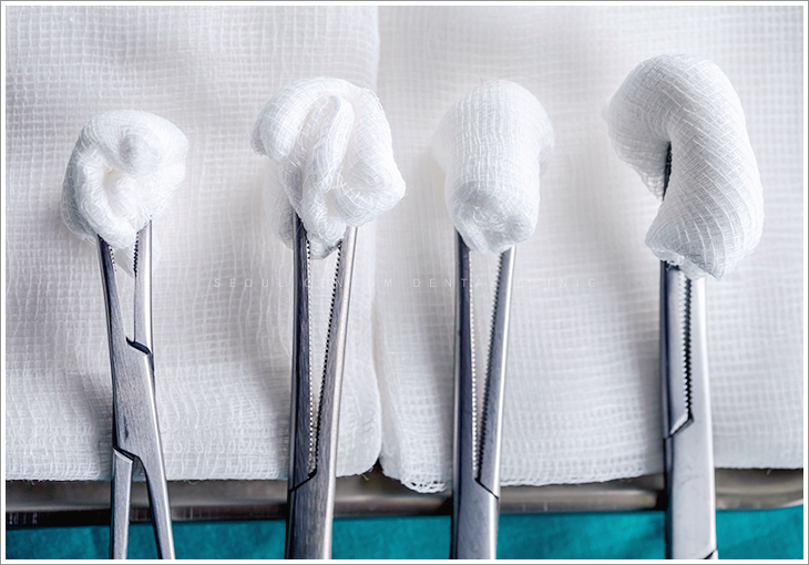 임플란트 수술 후 주의사항 5가지 어떤 게 속할까? 관련 이미지 3