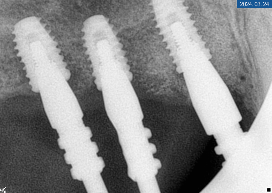 임플란트 브릿지와 크라운 수복으로 치아 기능을 회복시킨 증례 관련 이미지 17