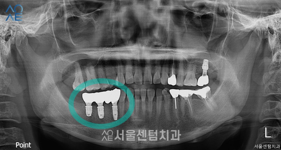 40대임플란트 수술 어떻게 하나요? 관련 이미지 4