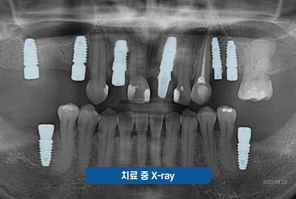 잠원역치과 임플란트 보험 실비 가능하나요? 관련 이미지 13