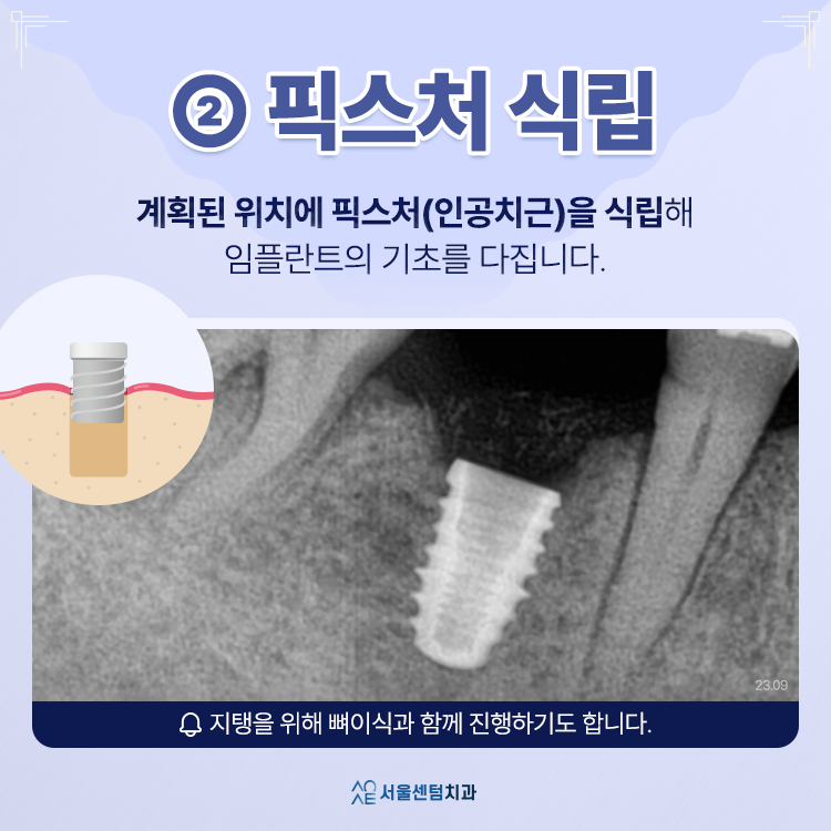 임플란트 할 때의 절차 과정은 대체로 이렇게 진행돼요 관련 이미지 3
