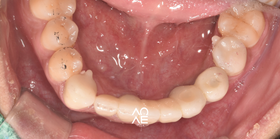 임플란트 뼈이식 필요한 경우 기간은? 관련 이미지 5