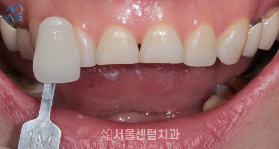 라미네이트 앞니 깨짐과 마모 해소한 증례 살펴보기 관련 이미지 4