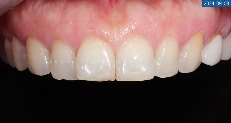라미네이트전후 치아의 가지런한 정도와 밝기 차이 확인하기 관련 이미지 10