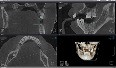 임플란트 브릿지와 크라운 수복으로 치아 기능을 회복시킨 증례 관련 이미지 7