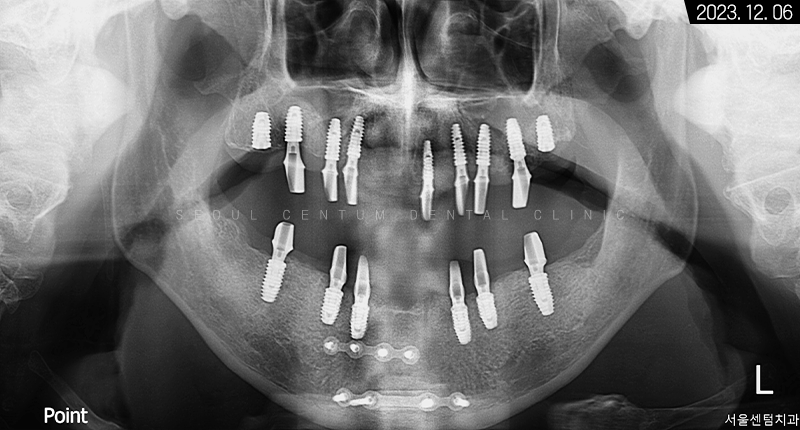 전체임플란트 기간 예상보다 줄어들 수 있는 방법과 증례 공개 관련 이미지 14