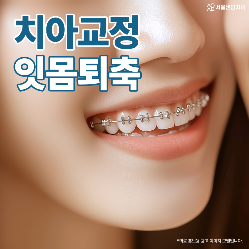 치아교정 잇몸 퇴축 왜 발생하고 어떻게 막을 수 있을까 관련 이미지 1