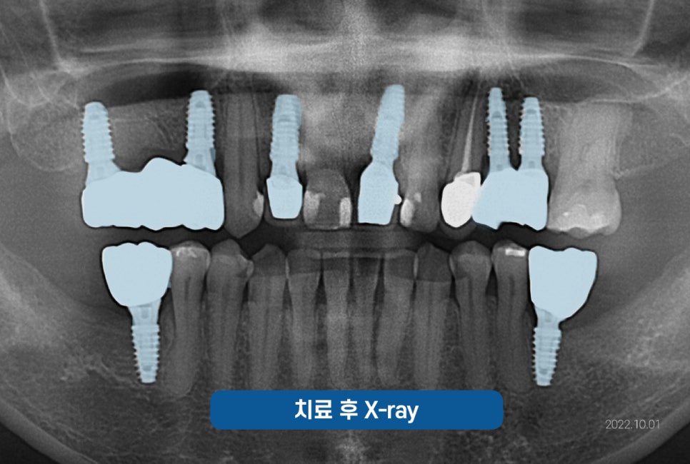잠원역치과 임플란트 보험 실비 가능하나요? 관련 이미지 14
