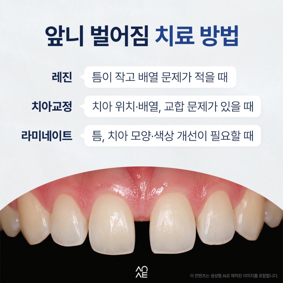 Is Sensitivity Severe After Veneers? What to Check Before Treating Gaps Between the Front Teeth image 6