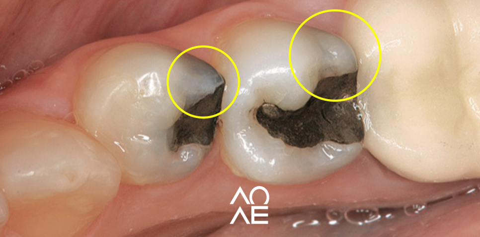 강남양심치과에서 오래된 아말감 교체하세요! 관련 이미지 5