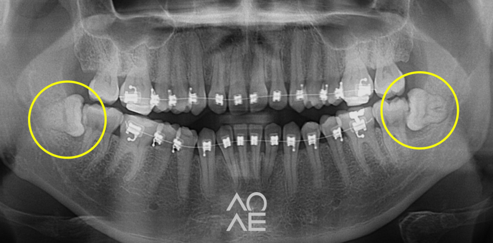 사랑니 발치 통증 붓기 줄이는 법 관련 이미지 5