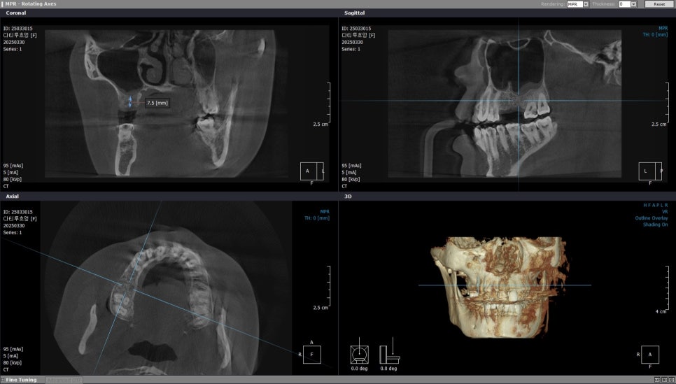 40대 임플란트 치료 케이스 상악동거상술 골이식까지 관련 이미지 3