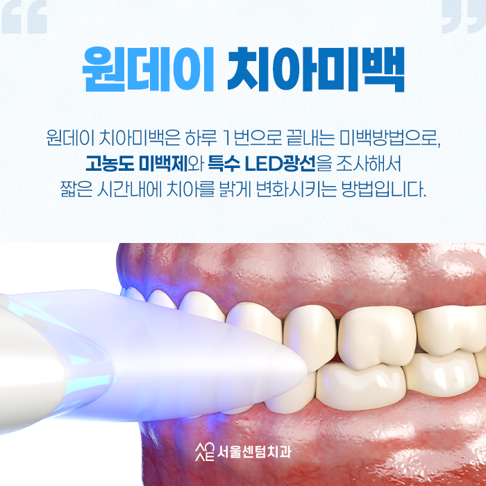 [신사역 치과] 원데이 치아미백 효과와 유지기간은 관련 이미지 3