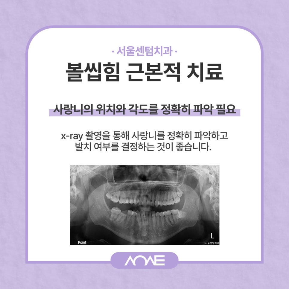 사랑니 볼씹힘 이렇게만 관리하세요 관련 이미지 4