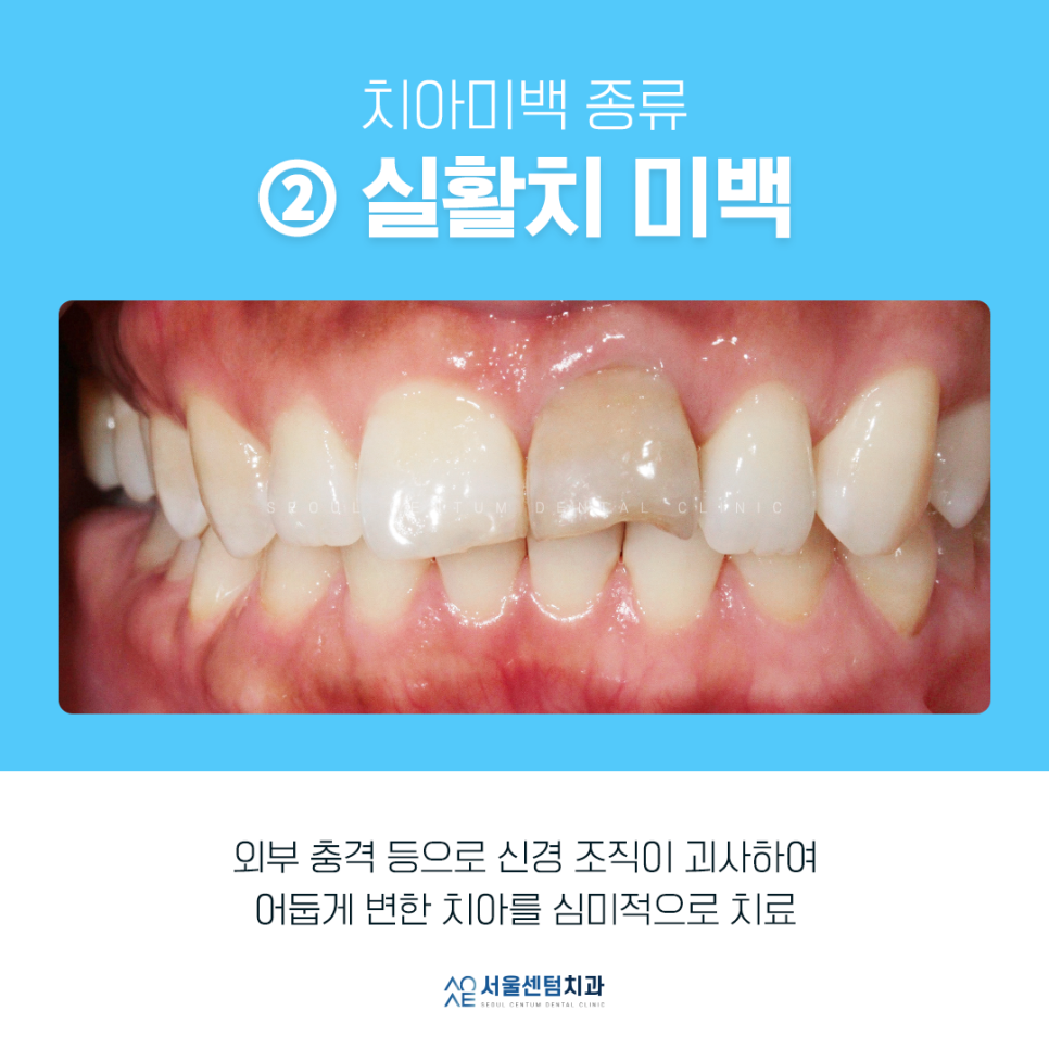치과치아미백 전후 사진과 종류 소개 관련 이미지 2