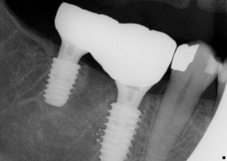 신사역치과 발치후 임플란트 시술과정 30대 남성 케이스 관련 이미지 6