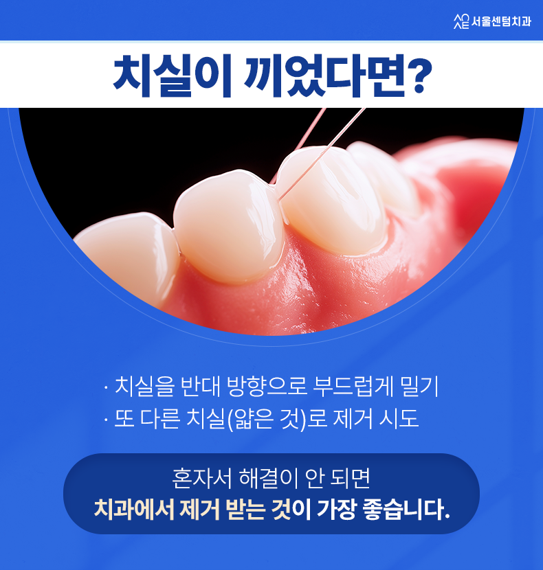 임플란트 치실 이 시기부터 이렇게 사용하세요 관련 이미지 5