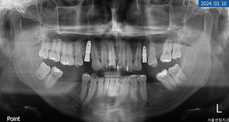 뼈이식 임플란트와 라미네이트 수복 증례 소개 관련 이미지 4