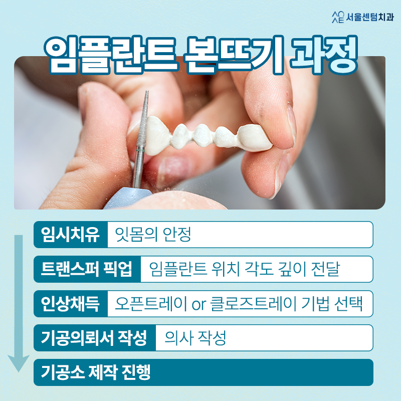 Why Is the Dental Implant Impression-Taking Process and Its Pain Precautions Important? image 2