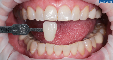 라미네이트전후 치아의 가지런한 정도와 밝기 차이 확인하기 관련 이미지 7