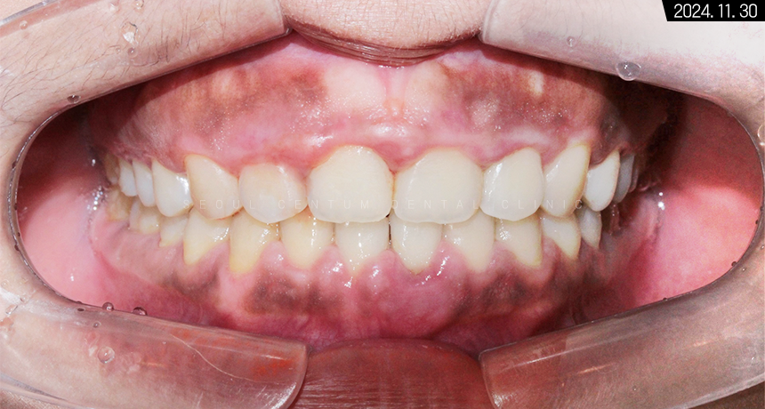 비발치로 돌출입 해소한 증례 관련 이미지 12