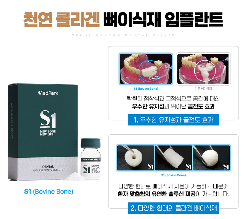치아 뼈이식 비용 얼마로 산정될까? 관련 이미지 7