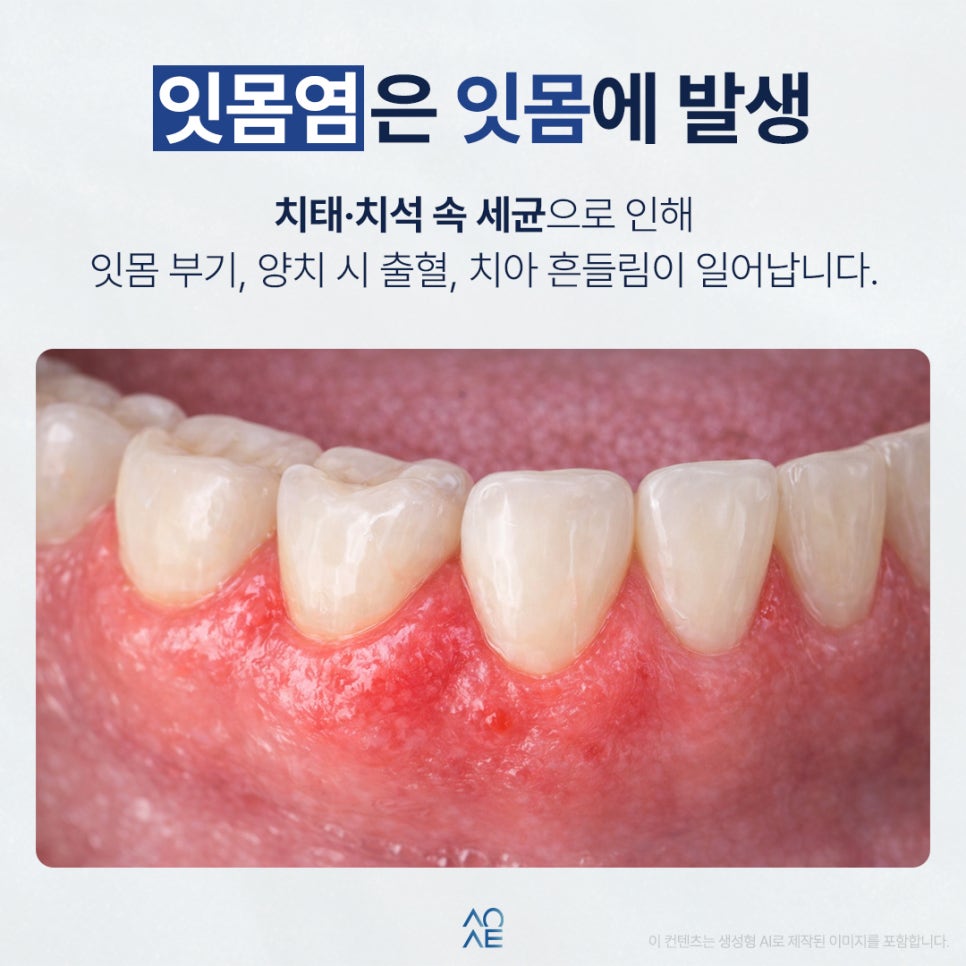구내염 잇몸염 모두 제대로 예방하고 싶은 분들만 보세요 관련 이미지 3