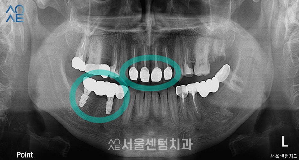 20대임플란트 처음이라 두렵다면 관련 이미지 5