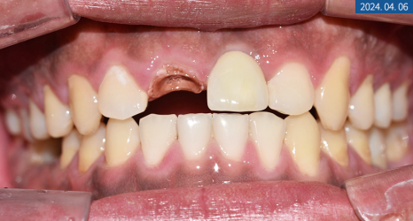 앞니 임플란트 식립으로 저작 기능을 끌어올린 증례 관련 이미지 8