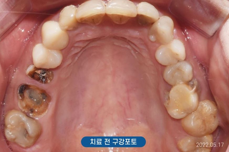 신사역주말치과 갑자기 어금니 이빨 부러졌다면 관련 이미지 4