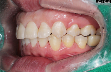 돌출입 및 신경치료와 임플란트 식립 동시 진행 증례 관련 이미지 29