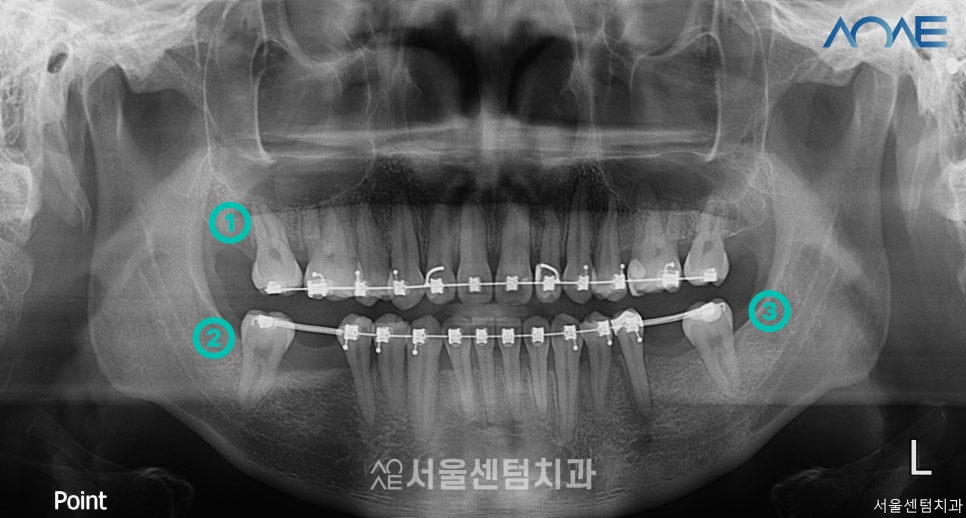교정임플란트 모두 맡겨주신 결과 관련 이미지 2