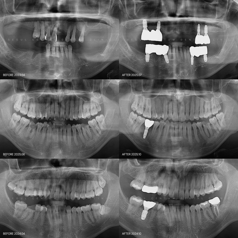 치과 임플란트 근심 걱정 놓기 위한 고려 사항 4가지 관련 이미지 6