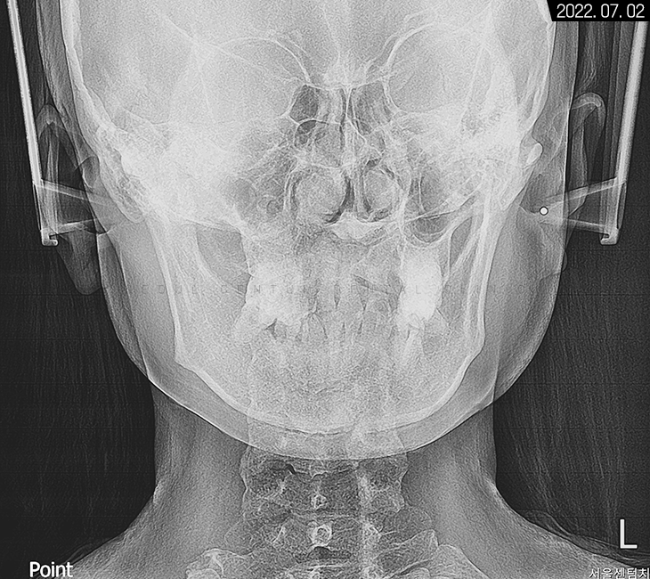 돌출입 및 신경치료와 임플란트 식립 동시 진행 증례 관련 이미지 6
