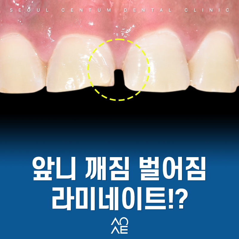 잠원동치과 무삭제 라미네이트 기간 앞니 깨짐 관련 이미지 6