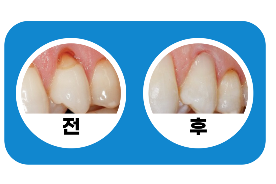 찬물 이시림 잇몸패임 원인 2가지, 치료법 관련 이미지 10