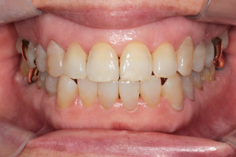 치아패임 이대로 두어도 괜찮을까요 치경부마모증 레진치료 관련 이미지 16