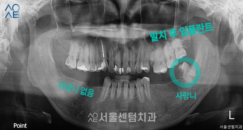 30대임플란트 치아상태 좋지 않아도 안심 관련 이미지 1