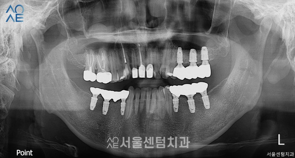 30대임플란트 치아상태 좋지 않아도 안심 관련 이미지 7